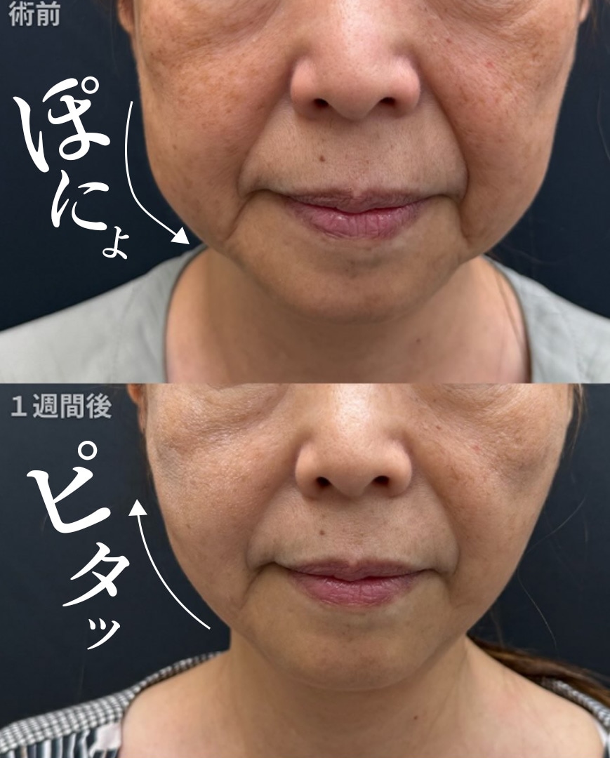 糸リフト症例ご紹介
