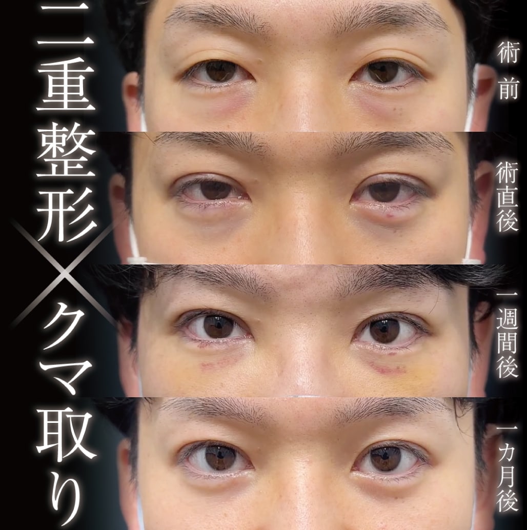 20代からも可能！<br />
<h2>6. クマ取り（経結膜脱脂法）</h2><p>