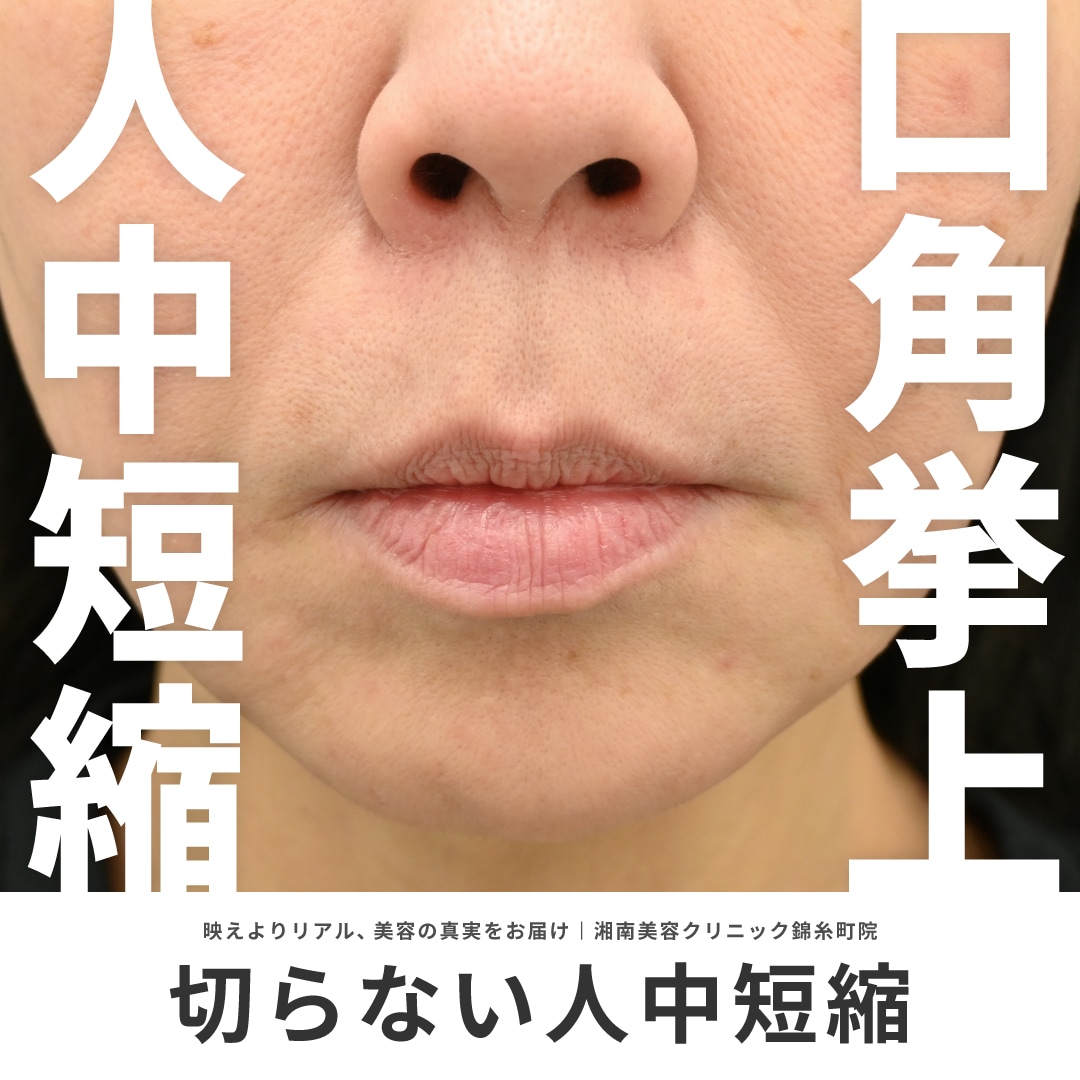 【切らない人中短縮＆切らない口角挙上】人中短縮したいけど切りたくない方必見！｜切らない人中短縮は男座医師