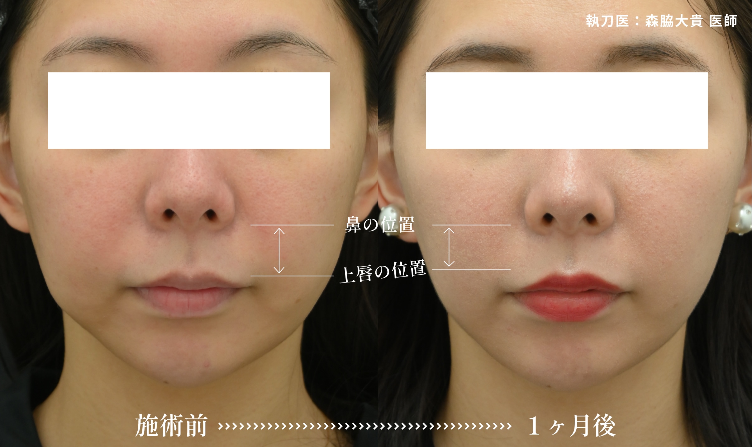 ナチュラルな仕上がりなので周りにバレづらいい切らない人中短縮
