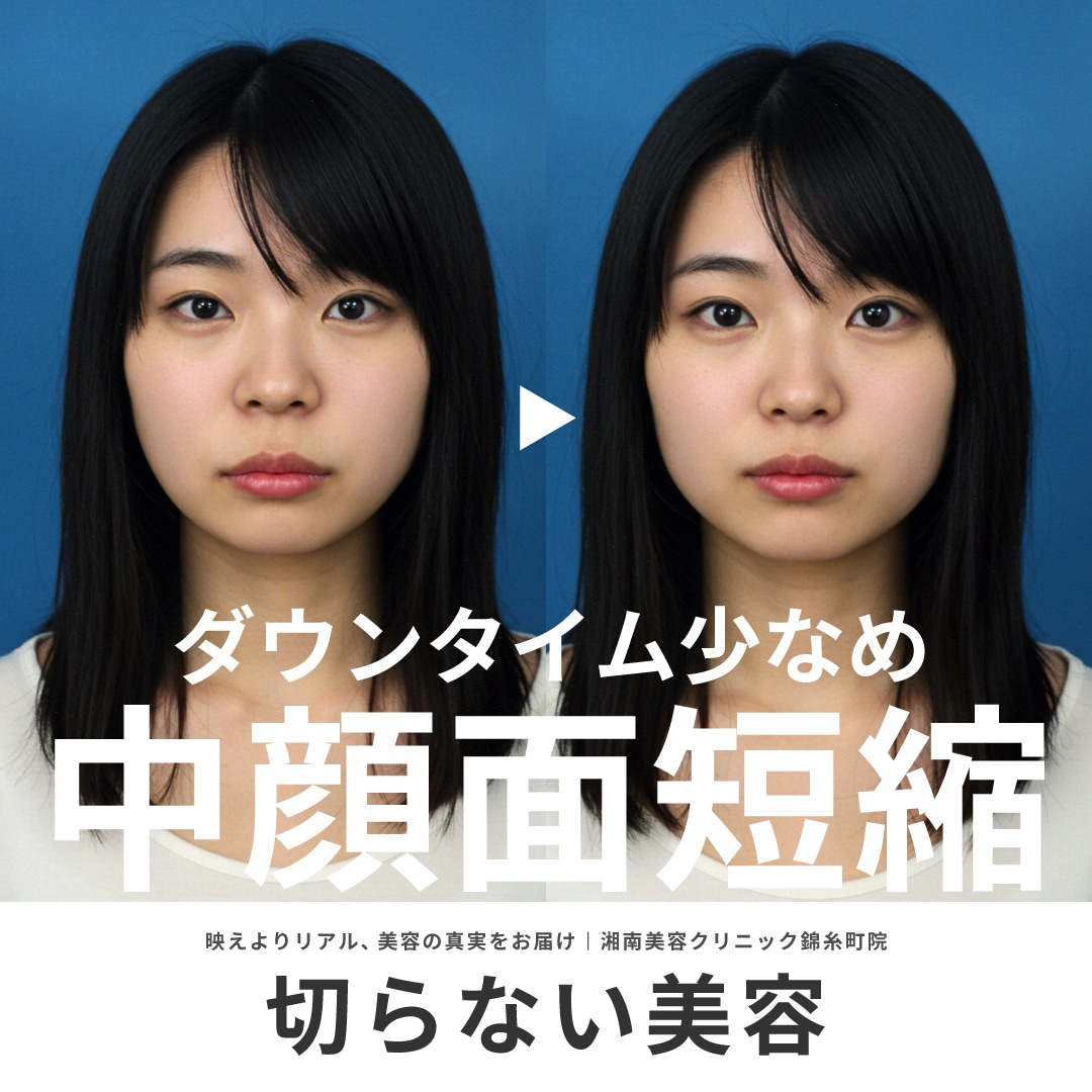 【切らない中顔面短縮】人中短縮・口角挙上・ヒアルロン酸｜湘南美容クリニック錦糸町院
