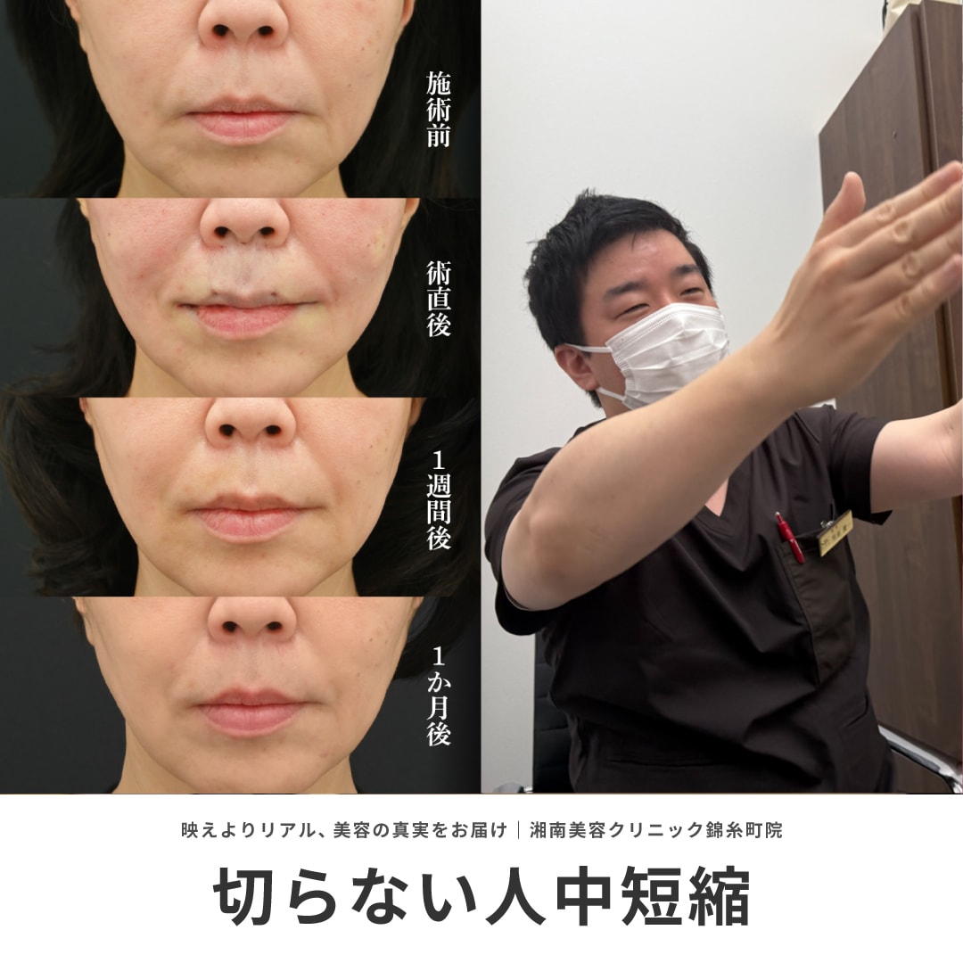 【切らない人中短縮】SBCグループで数少ない施術を錦糸町院男座医師で受けられます！