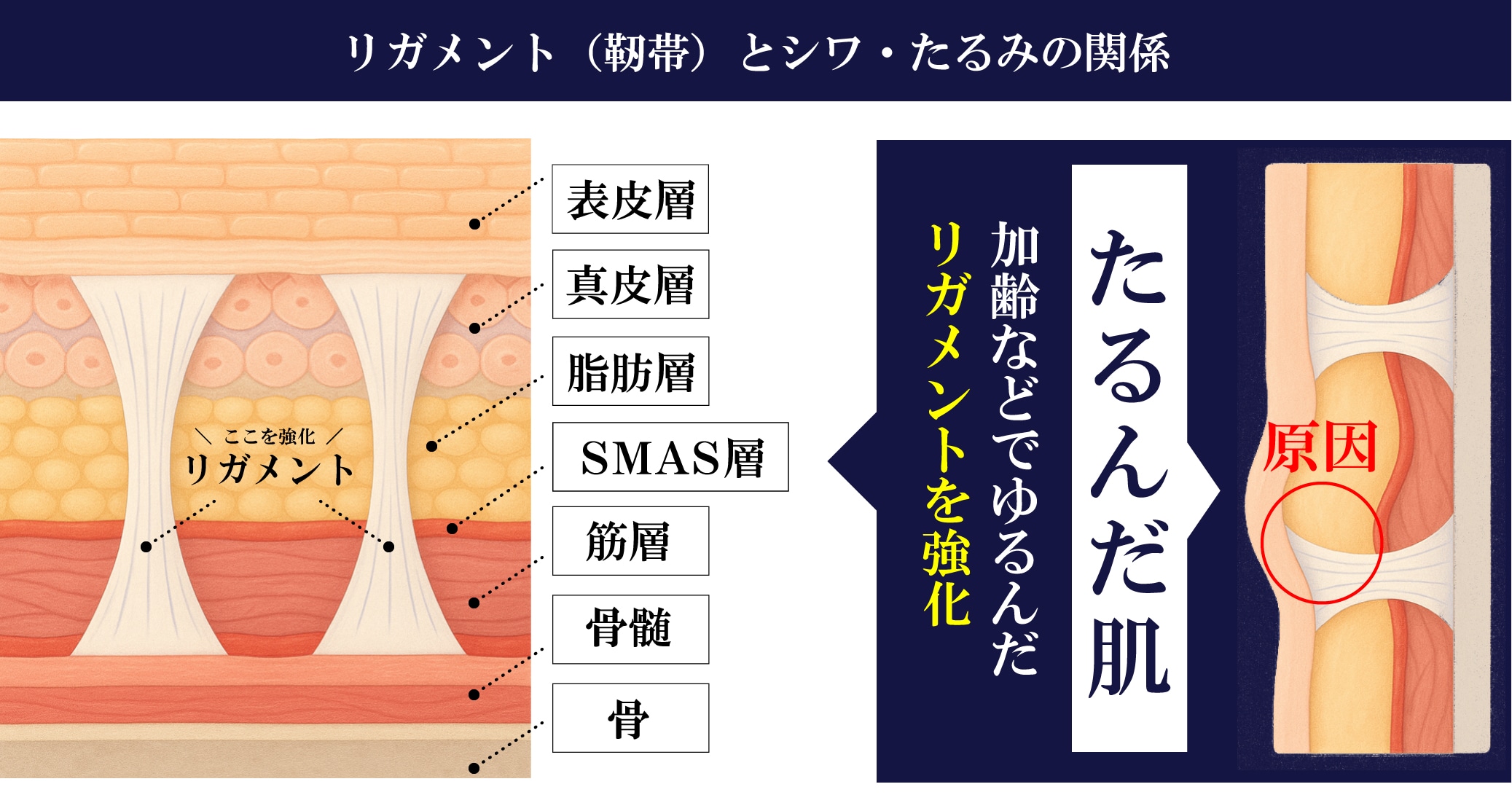 ポイント2：土台からのリフトアップ