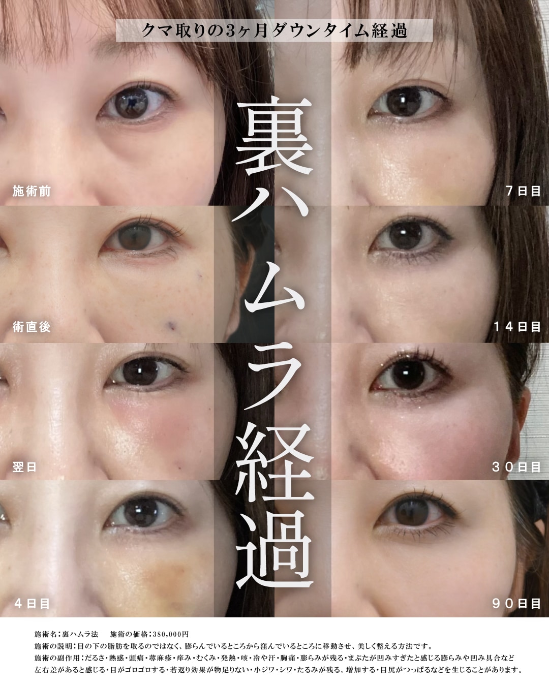 皮膚を切らないから傷跡がバレない！