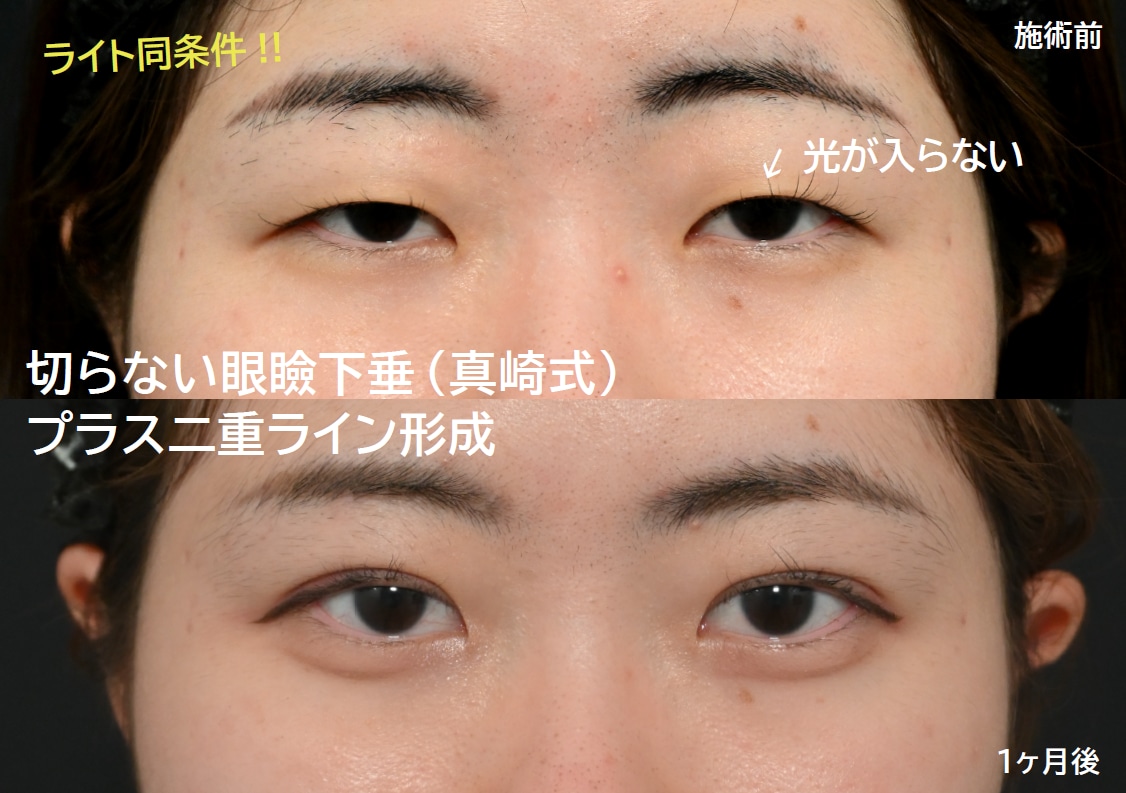 切らない眼瞼下垂の症例写真