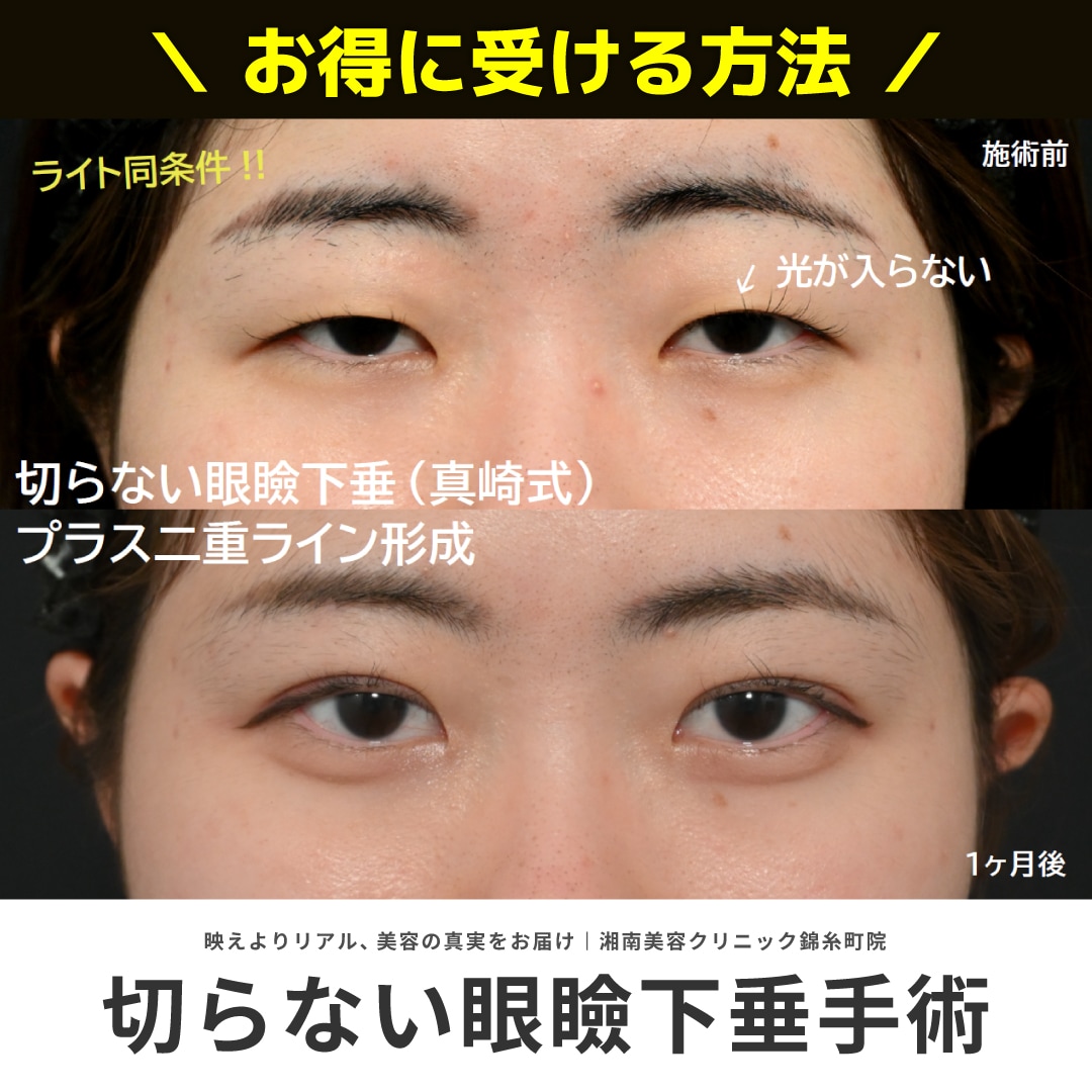 切らない眼瞼下垂 真崎式の上手いおすすめの先生と安くお得に受ける方法とは｜湘南美容クリニック錦糸町院