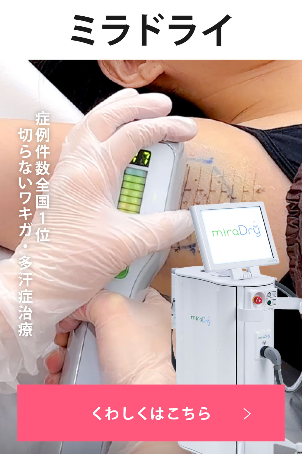 症例件数全国1位(2024年上半期SBC内)のワキガ・多汗症治療「ミラドライ」
