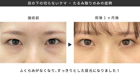 脂肪注入なしでもクマ取りはできますか？