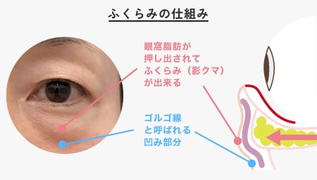 影クマさんにおすすめの治療は【目の下の切らないクマ・たるみ取り×脂肪注入】