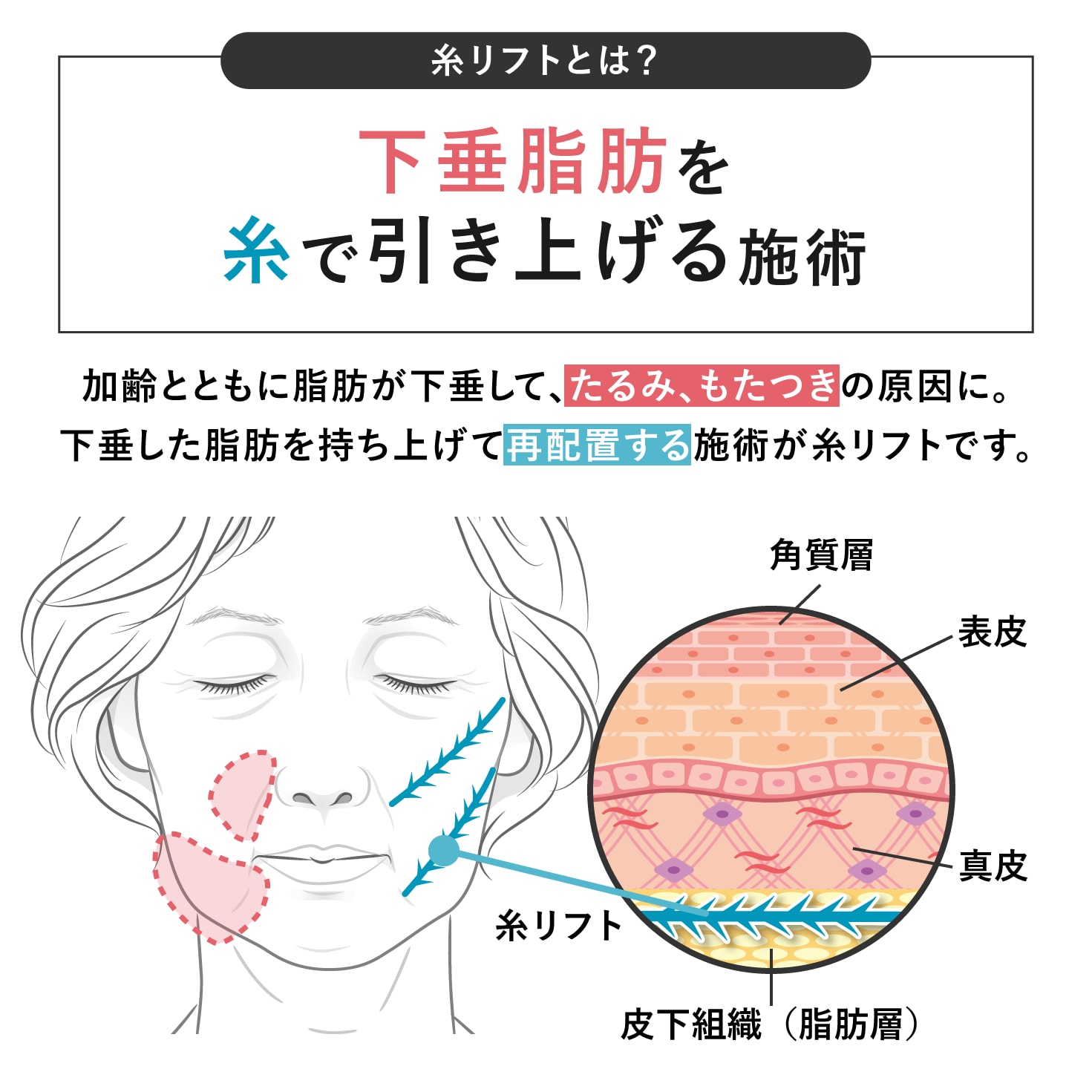 糸リフトとは？