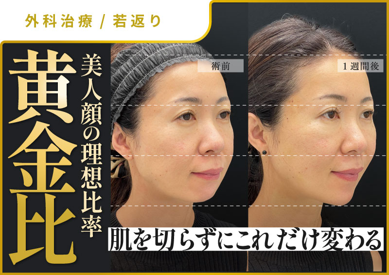 肌を切らずに美人顔の黄金比に