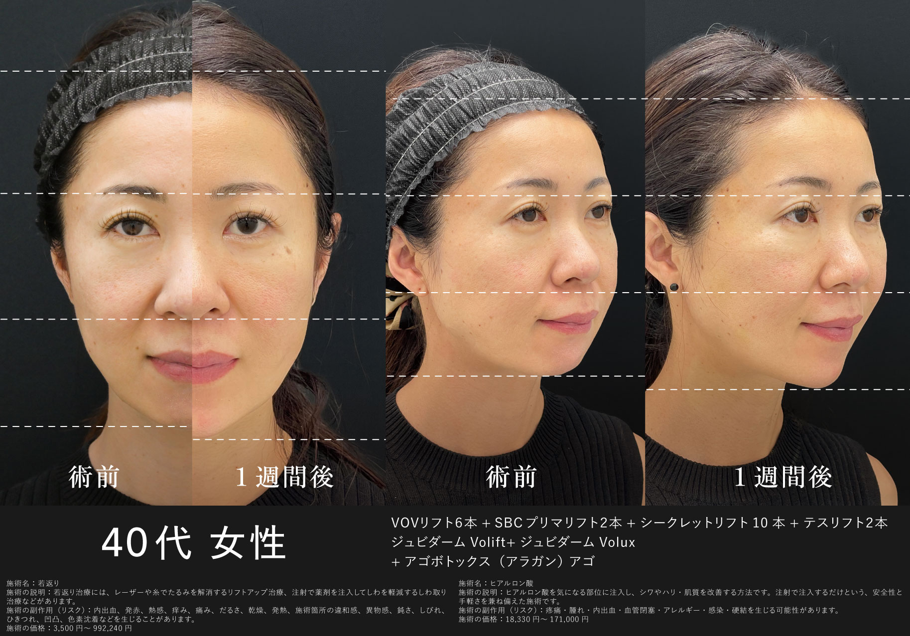 足りないボリュームを補う裏ワザ「ヒアルロン酸」