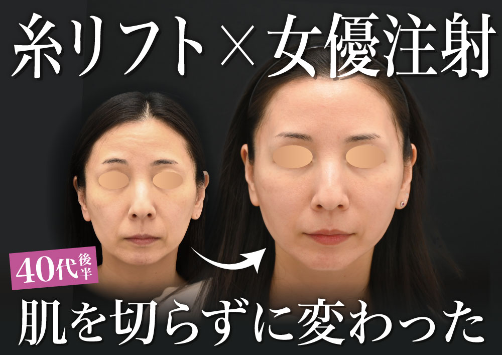 糸リフト関東おすすめドクターのおすすめ本気のアンチエイジング治療セット
