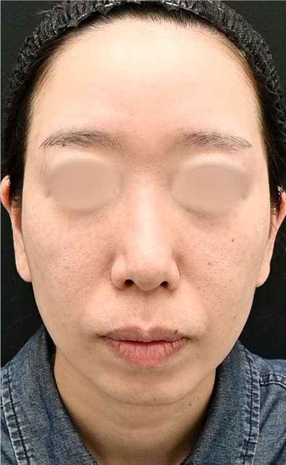 {糸リフト+脂肪注入} {40代} {女性} の術前の症例写真