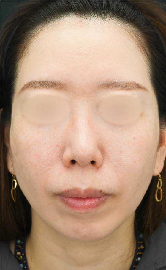 {糸リフト+脂肪注入} {40代} {女性} の術前の症例写真