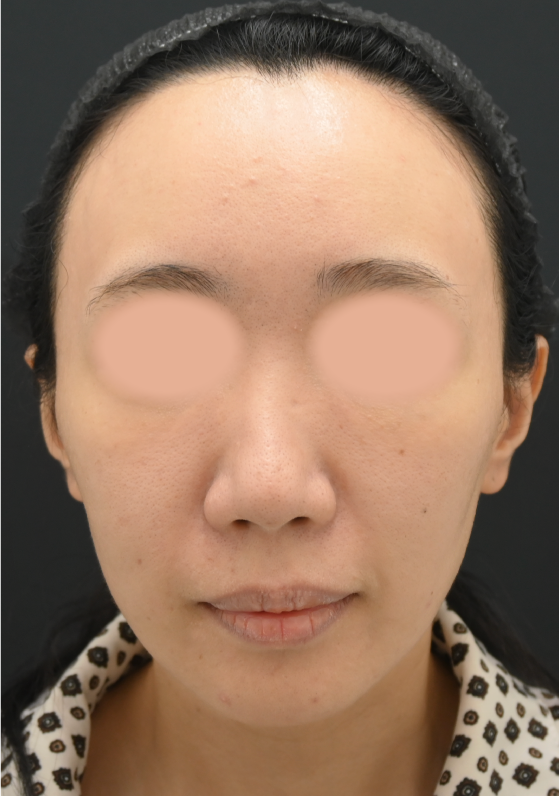 {糸リフト+脂肪注入} {30代} {女性} の術前の症例写真