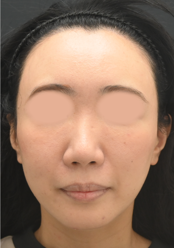 {糸リフト+脂肪注入} {30代} {女性} の術前の症例写真