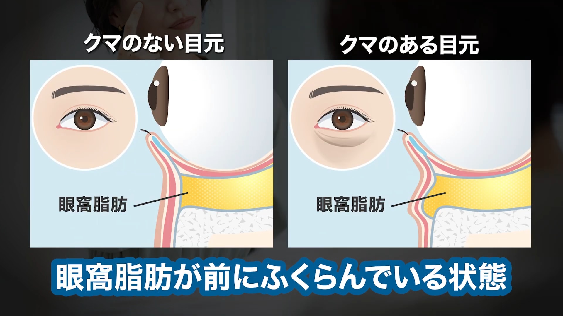 目の下のたるみには「クマ取り」