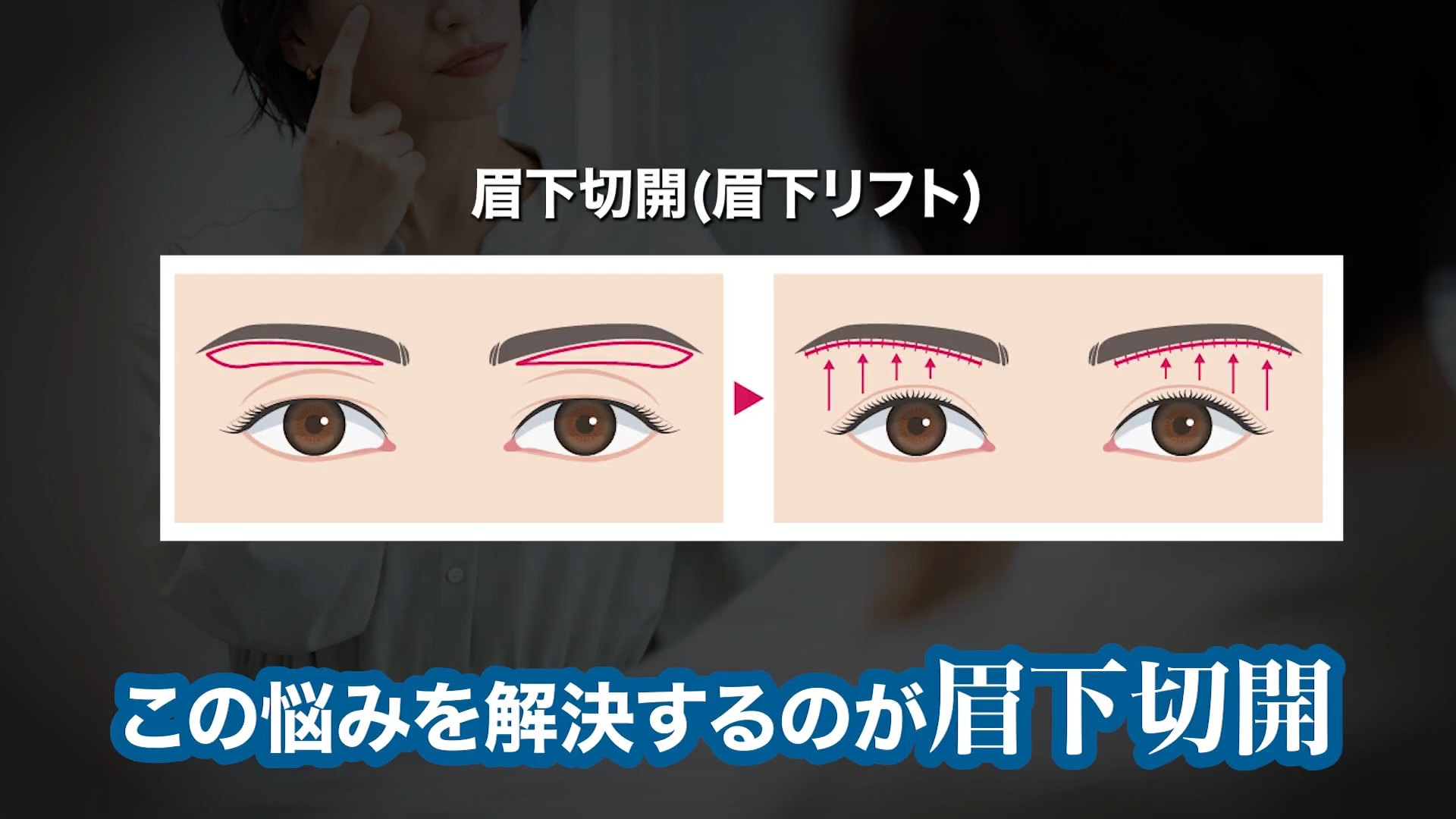 目の開きが悪い状態には「眉下切開」