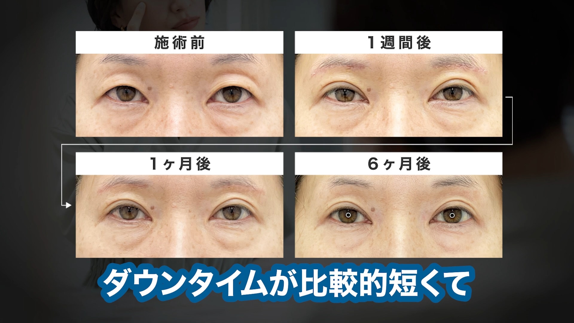 皮膚を切り取るのにダウンタイムが短い？