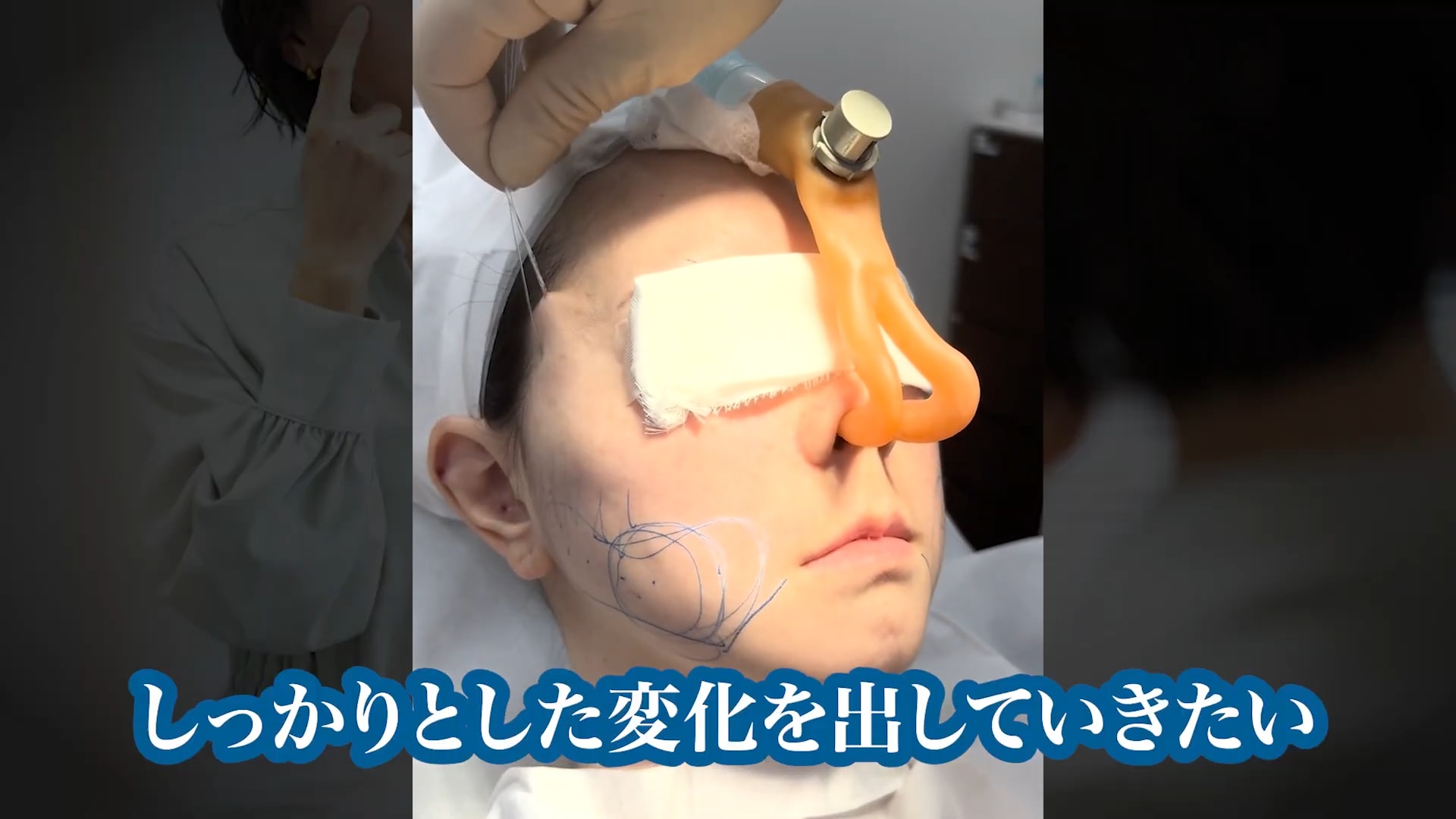 顔の脂肪の引き上げには「糸リフト」