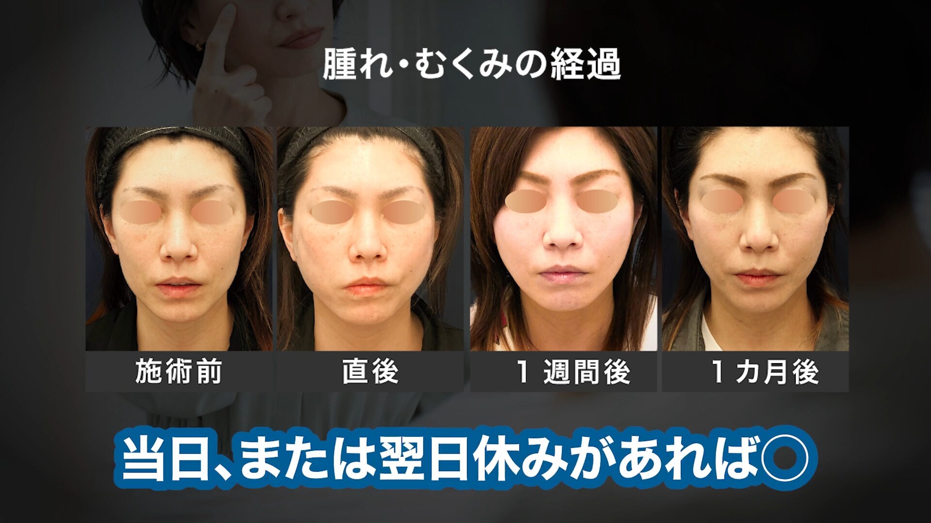 ダウンタイムが短い