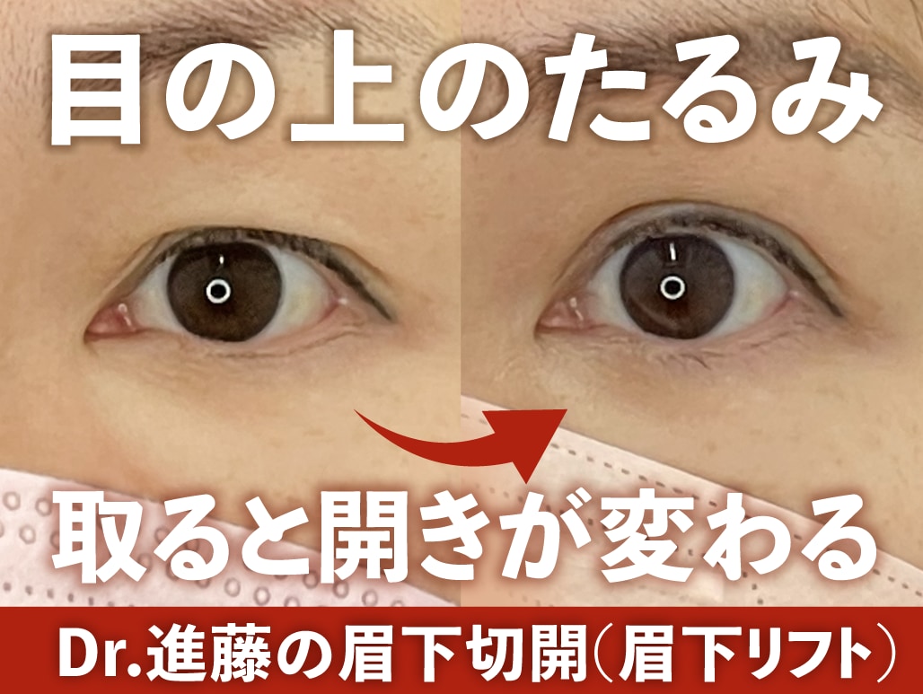 目の開きが変わる!上まぶたのたるみをとって若々しい目元に! 眉下切開を受けるなら、若返り治療のプロ北千住院進藤医師にお任せください