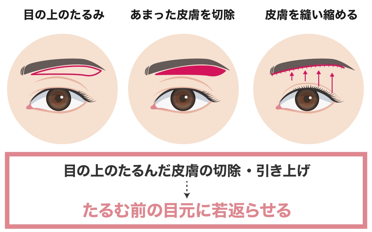 たるみを切除して、たるむ前の状態に戻す⁉︎