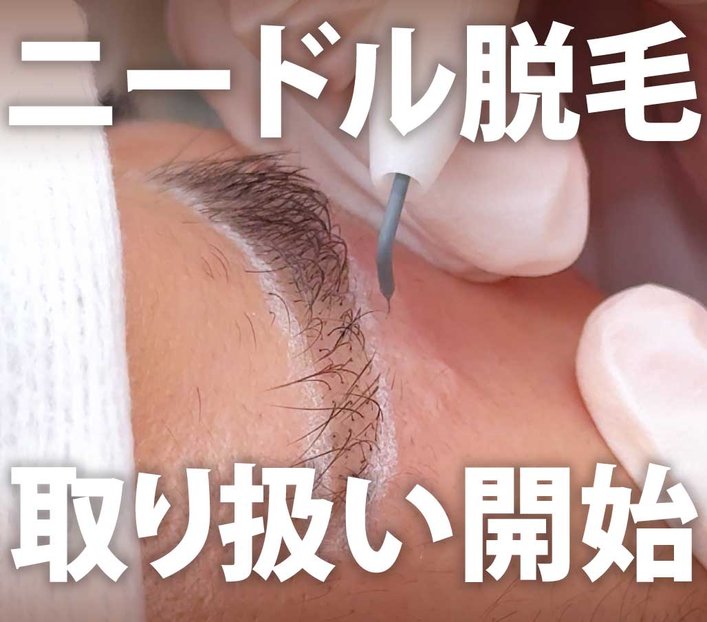 【新規取り扱い開始】待望のニードル脱毛をSBC北千住でも取り扱い開始！！