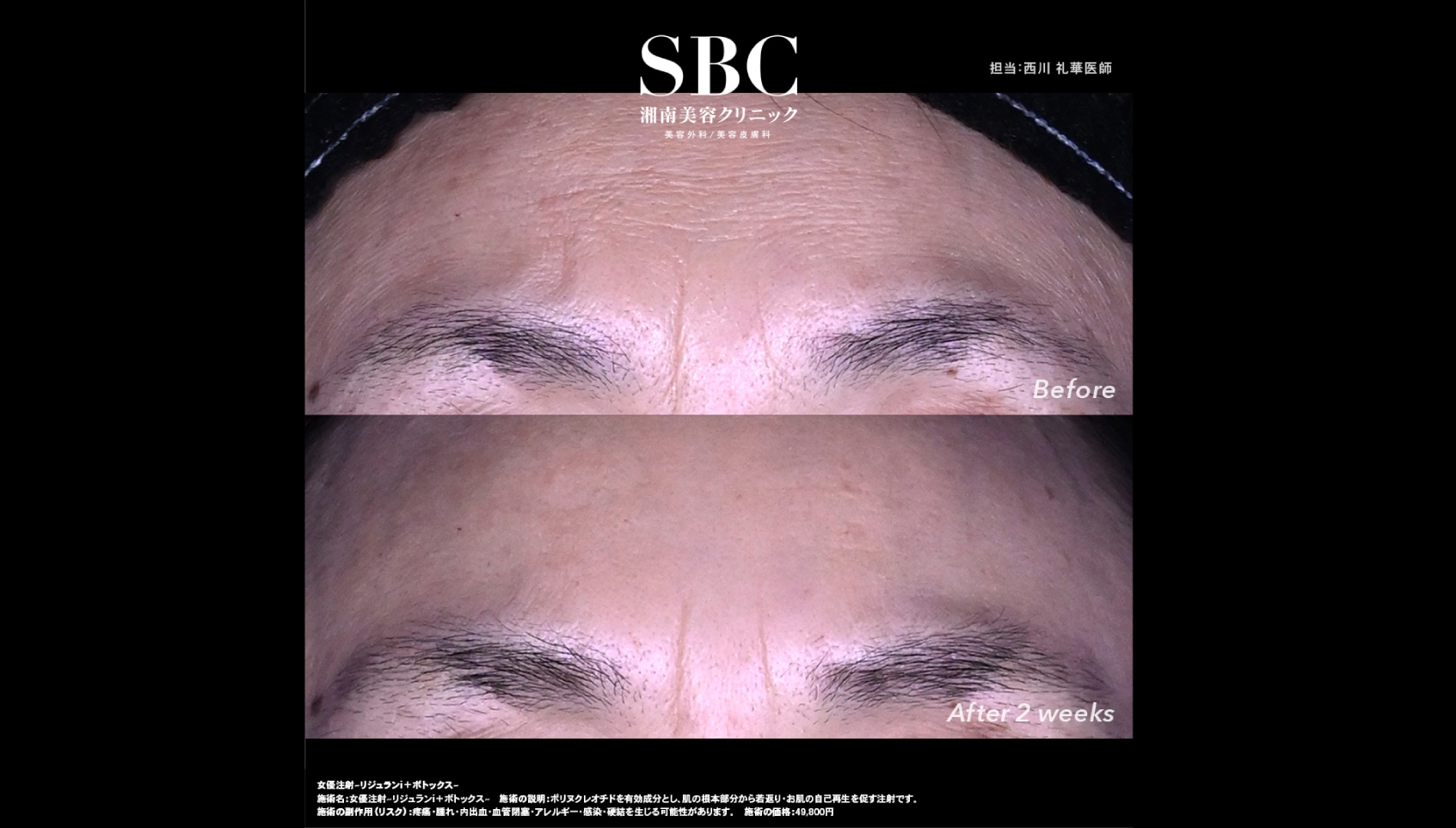 女優注射