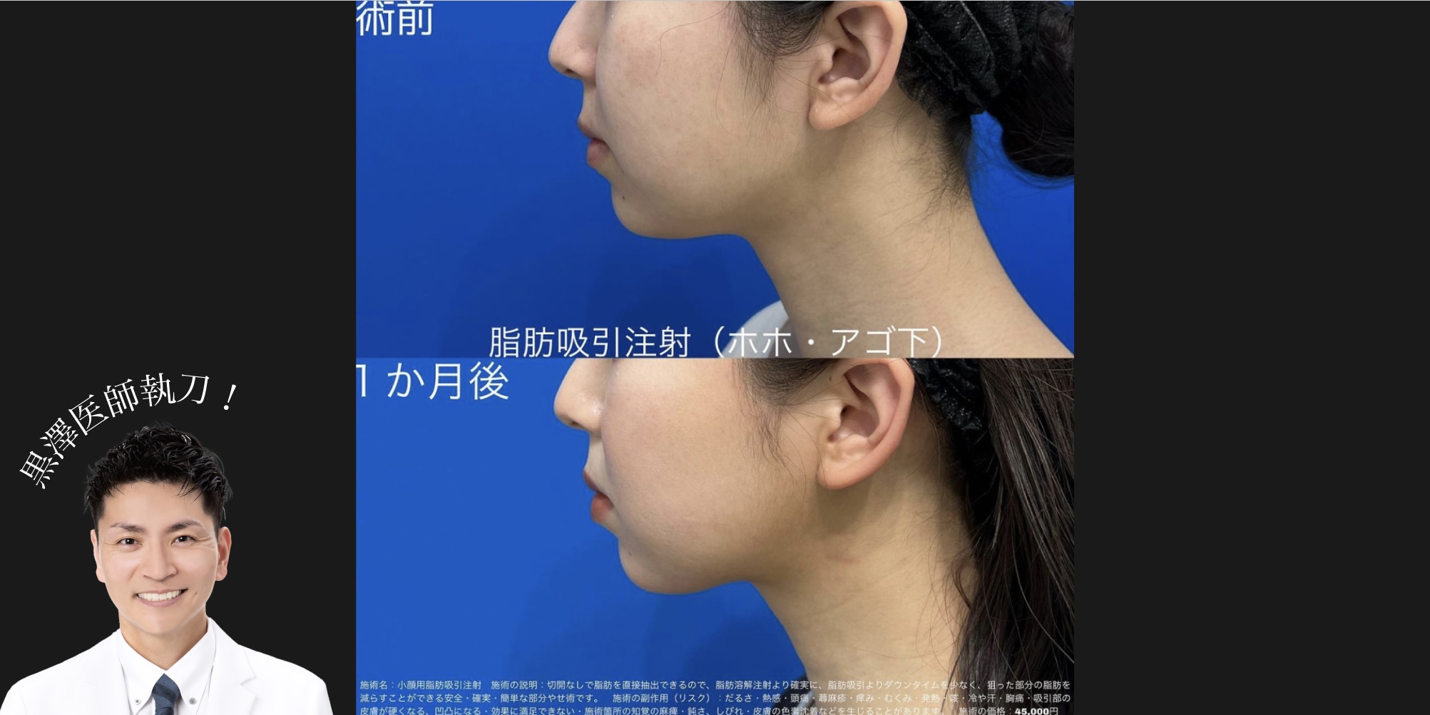 脂肪吸引注射