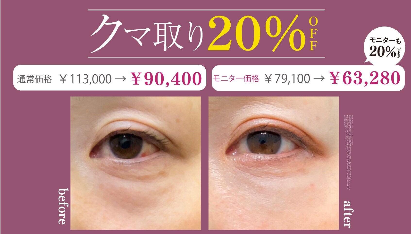 クマ取り20%OFF