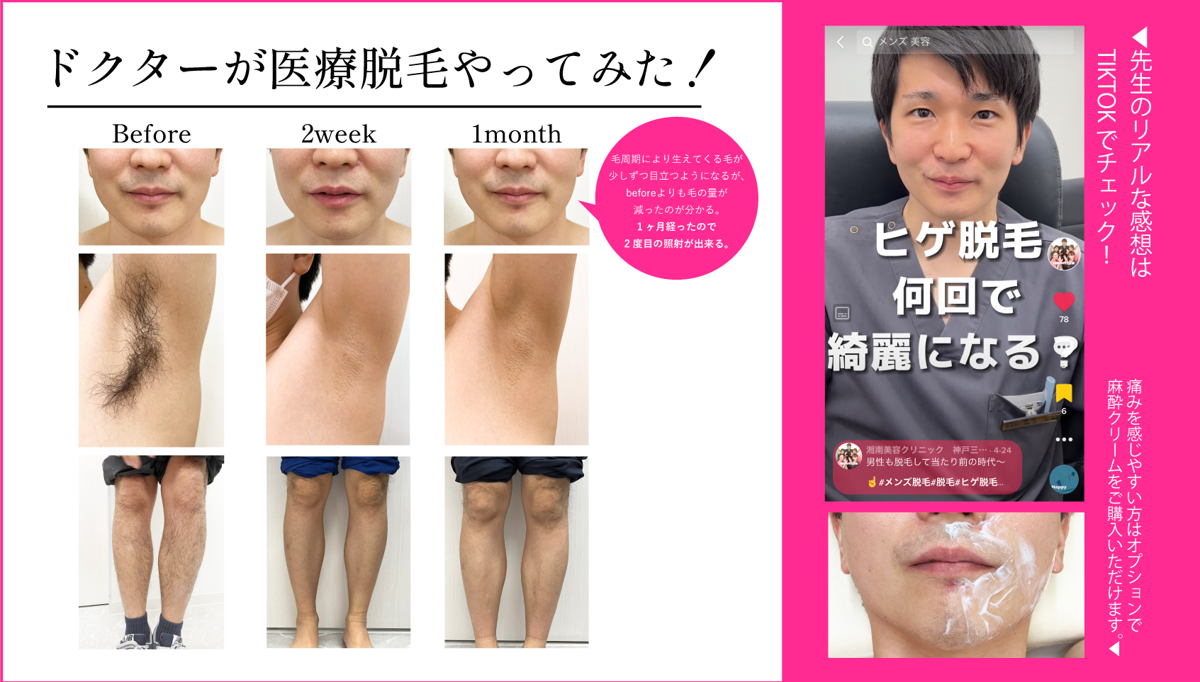 男性脱毛は当たり前の時代！