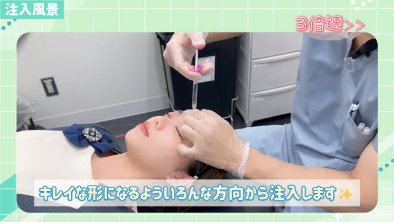 ヒアルロン酸注入