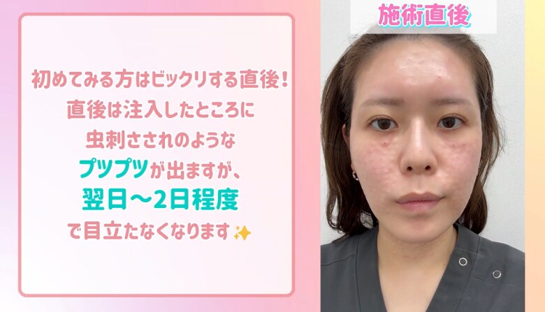 施術直後～1週間後の経過