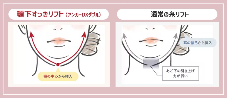 あご下の高い引き上げ力
