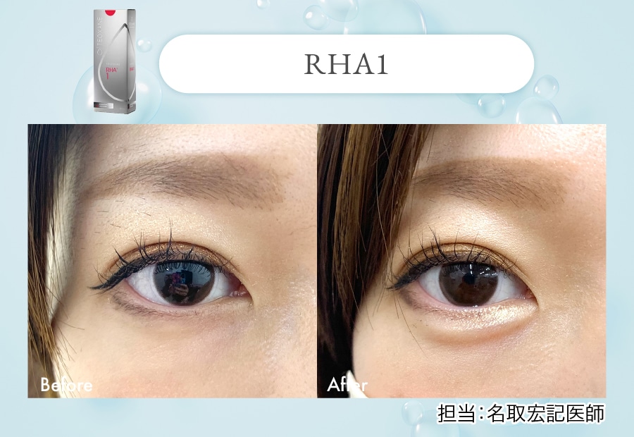 若い子に大人気！唇や涙袋をぷっくりとさせたい方
