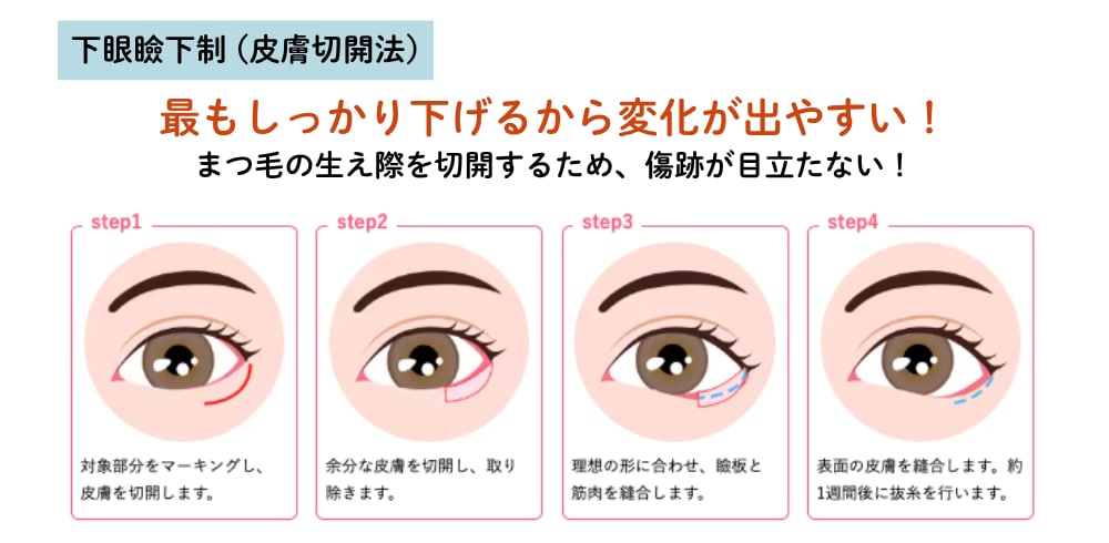 下眼瞼下制法の違いとは？