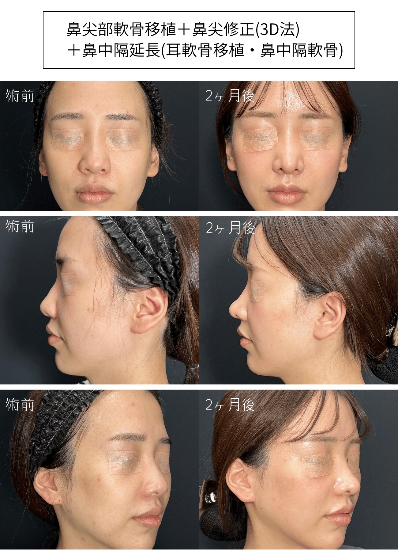 鼻先の厚みを解消！