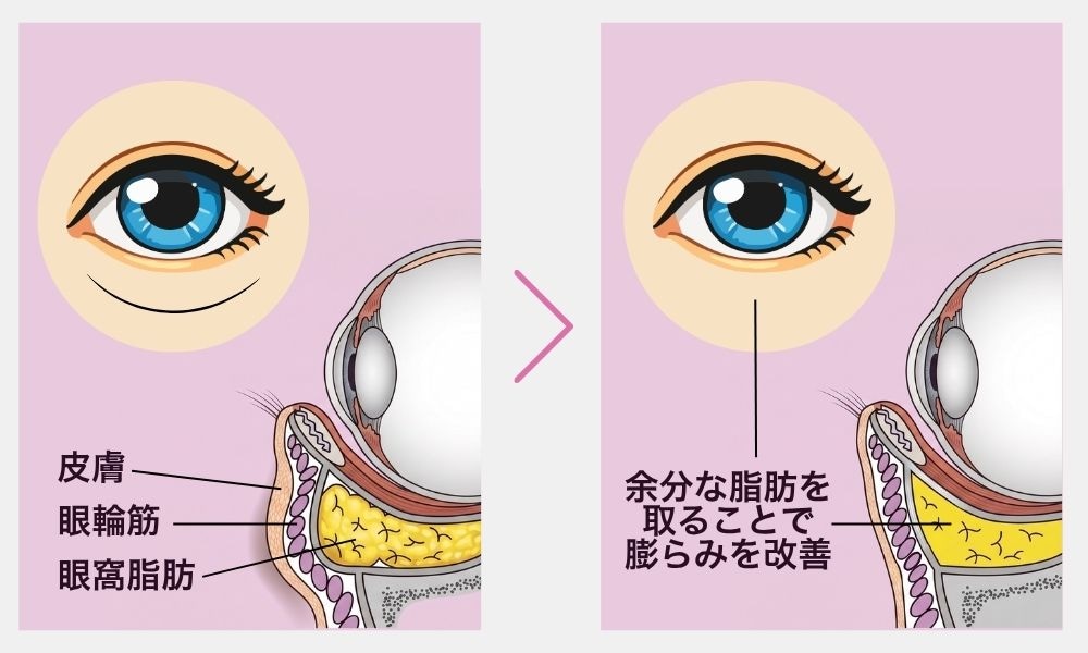 目の下の切らないクマ・たるみ取り
