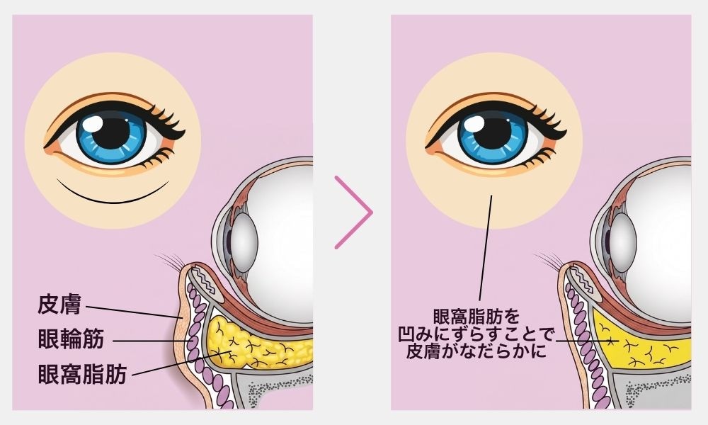 裏ハムラ