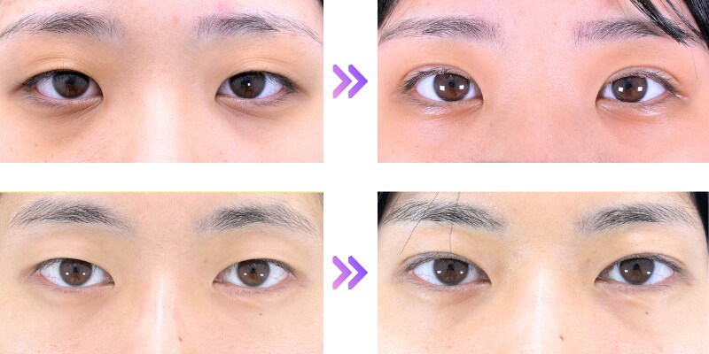 Dr.平出の垢抜け埋没二重👀✨