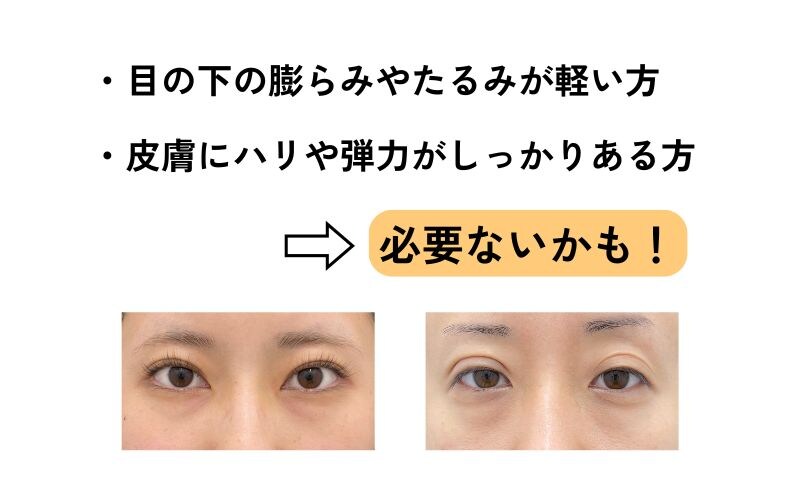 脂肪注入が必要ない人