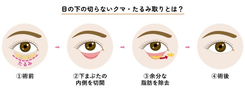 クマ取りってどうゆう治療？