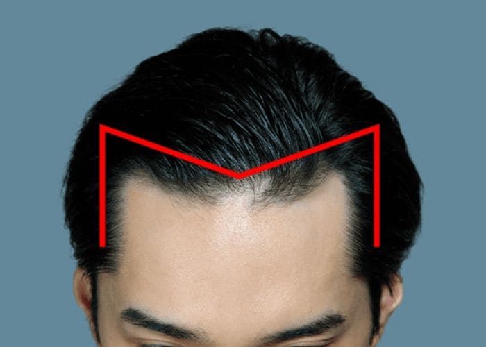 自分はM字ハゲ？