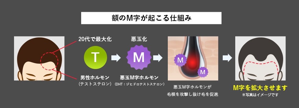 AGAによるM字ハゲは放置が1番厳禁なんです