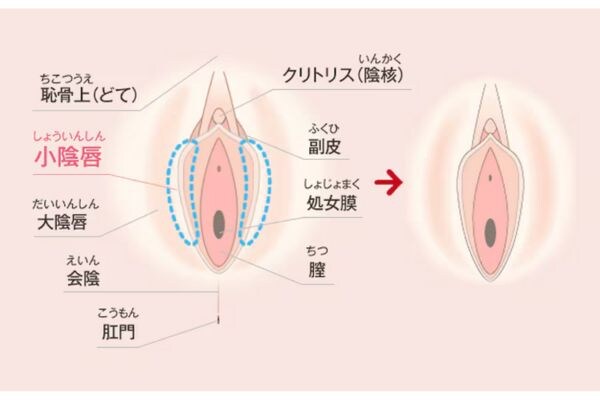 小陰唇縮小術 (抜糸あり・抜糸なし)<br />
