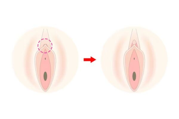 陰核包茎術(抜糸あり・抜糸なし)<br />
