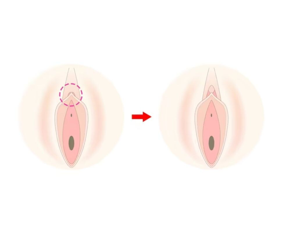 【陰核包茎術】不感症や性行為時の痛みにお悩みの方へ