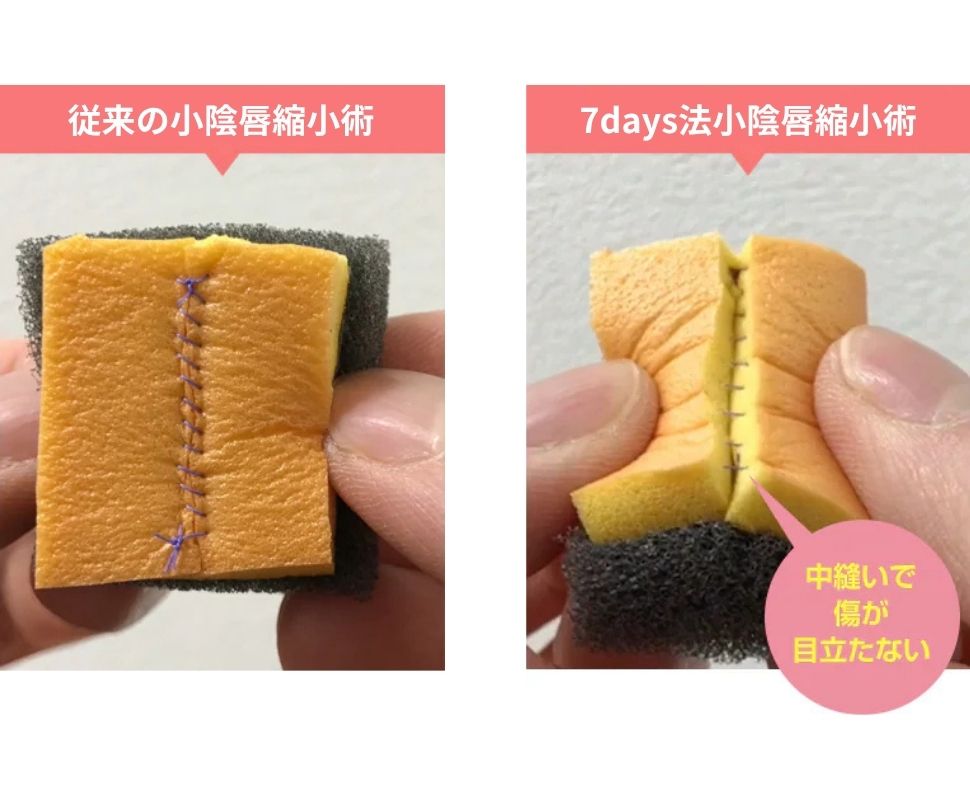 抜糸なし7days法